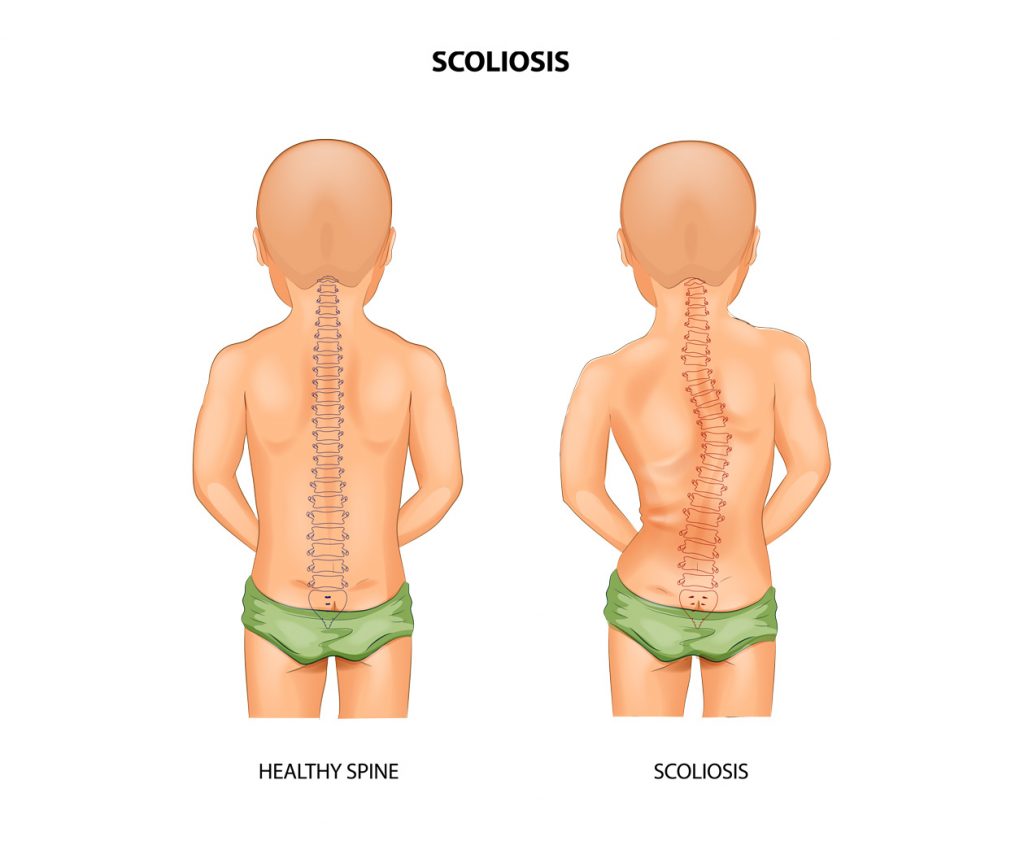 Scoliosis