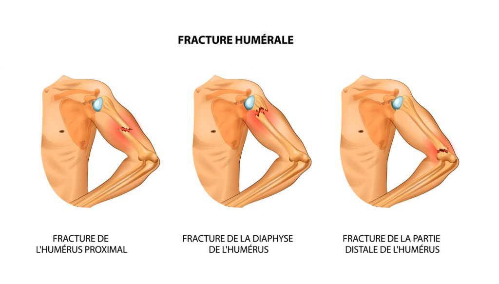 Fracture humérale