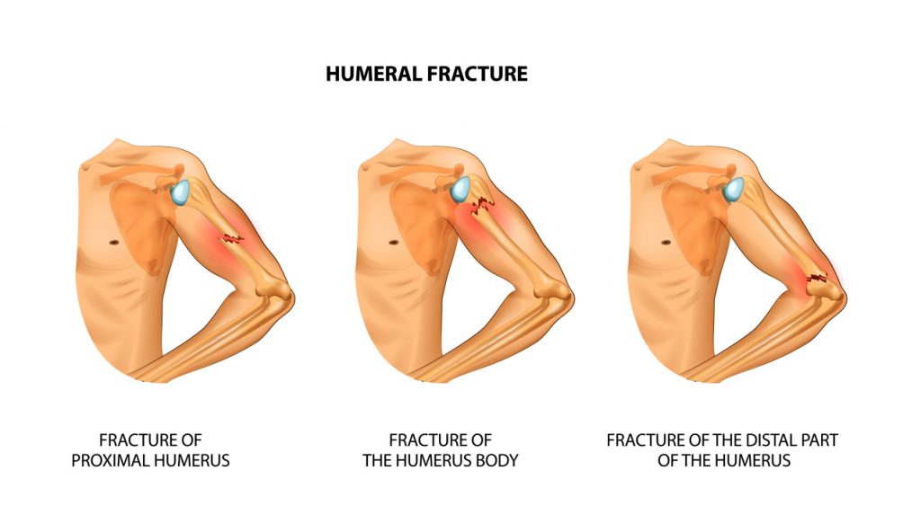 Humeral fracture